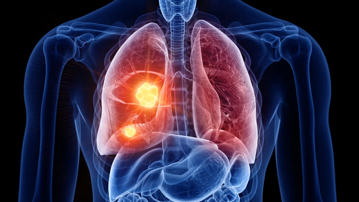Thoracic Oncology